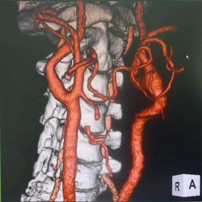 頚部CT-3D