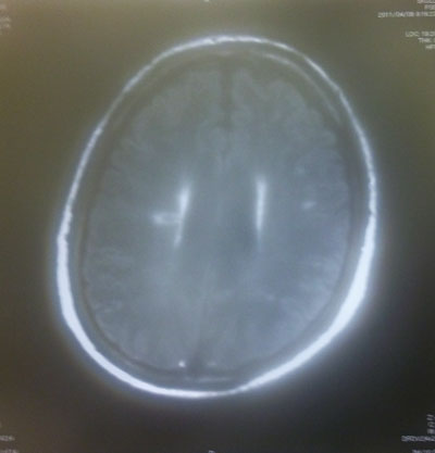 頭部-MRI